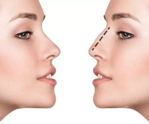 جراحی بینی در ایلام