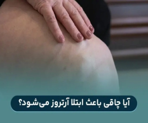 ابتلا به آرتروز به دلیل چاقی و اضافه وزن