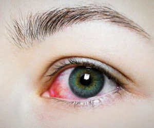 کمک های اولیه چشم