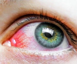 آلرژی چشم