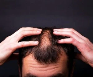 طاسی زودرس
