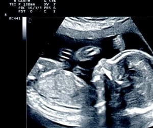 سونوگرافی در بارداری