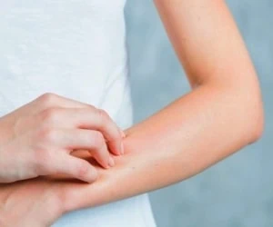 ارتباط استرس و اگزما + دلیل تشدید
