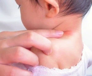 حساسیت غذایی