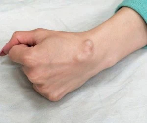 غده چربی زیر پوست