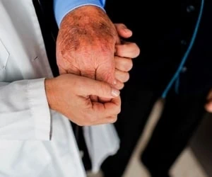 بیماری آلزایمر