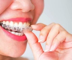 ارتودنسی نامرئی