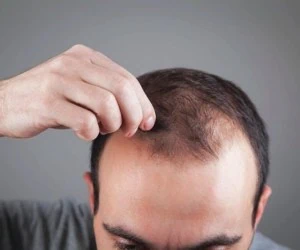 بی خوابی ریزش مو