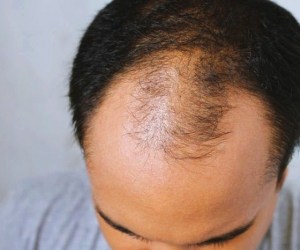 ریزش موی نوجوانی