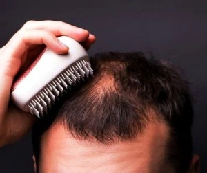 آلوپسی اره اتا