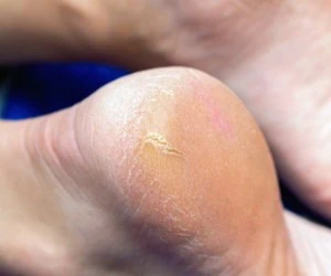 درمان خانگی ترک پاشنه پا