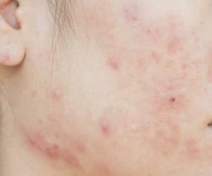 درمان جای جوش