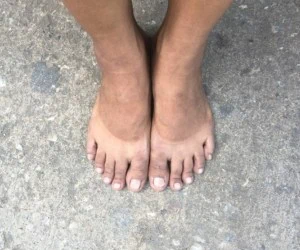 بعد آفتاب سوختگی