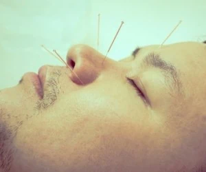 طب سوزنی مثل بوتاکس