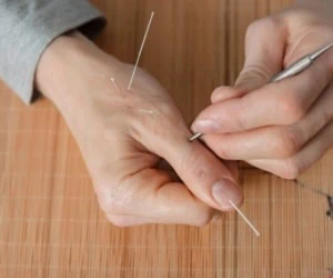 طب سوزنی برای درمان چاقی