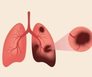 پاکسازی ریه افراد سیگاری