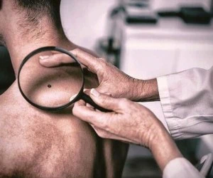 علائم خال سرطان