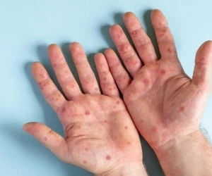 آبله میمونی