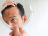 درمان ریزش موی در شقیقه ها