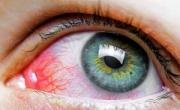 آلرژی چشم