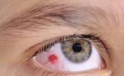 درمان لکه خون در چشم