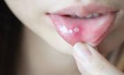 آفت دهان و زبان 