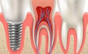 ایمپلنت کاشت دندان