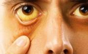 زردی چشم
