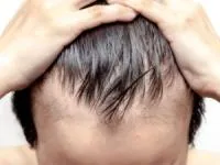 درمان ریزش مو شدید در سریع‌ترین زمان