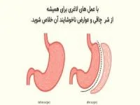 عمل لاغری توسط بهترین جراح در اراک