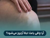 ابتلا به آرتروز به دلیل چاقی و اضافه وزن