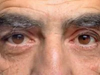 آب مروارید