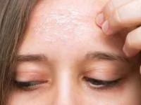 لایه بردار پوست