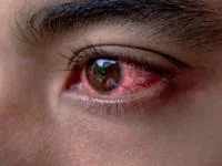 قرمزی چشم