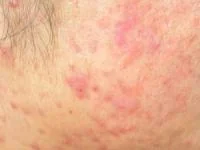 جوش و آکنه