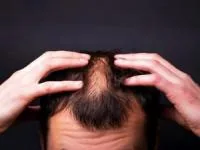 طاسی زودرس