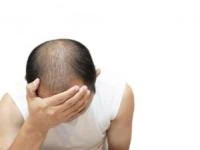 ریزش مو