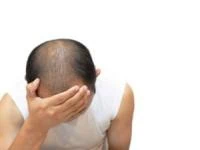 درمان جدید ریزش مو
