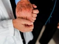 بیماری آلزایمر