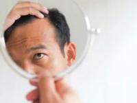 درمان ریزش موی در شقیقه ها