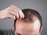 بی خوابی ریزش مو