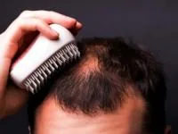آلوپسی اره اتا