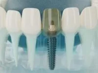 شکست ایمپلنت دندان