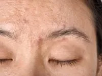 قرص آکنه