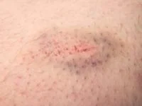 علت کبودی پوست