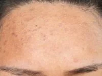 آکنه