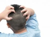 اگزما پوست سر