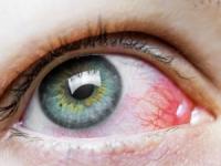 درمان قرمزشدن چشم