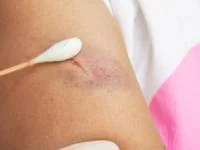 بتادین برای زخم