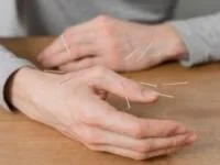 طب سوزنی